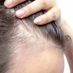 Dita che sfiorano la cute, evidenziando diradamento e sottili capelli. Un segno visibile di alopecia da stress.