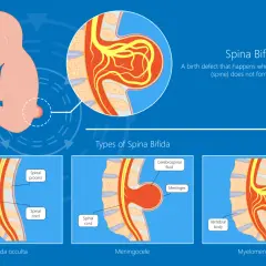 Ilustracja pokazuje wady kręgosłupa u niemowlaka: spina bifida occulta, meningocele i myelomeningocele, gdzie wystający kręgosłup jest widoczny.