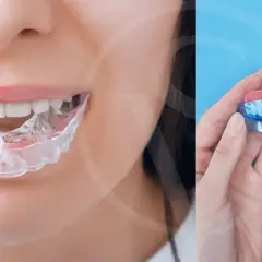 Protector bucal transparente para ayudarte como evitar el bruxismo. En manos, un protector bucal de dos piezas.