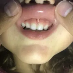 Boca de niño con dientes frontales y el frenillo del labio inferior visible.