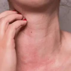 Alergia na słońce: objawy, przyczyny i jak sobie z nią radzić?