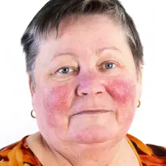 Kvinna med rodnad i ansiktet, troligen rosacea. Hennes hals är också påverkad.