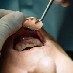 Dentysta używa lusterka, by sprawdzić, co wyciąga ropę z zęba.