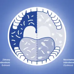 Porównanie zdrowego i niezrównoważonego mikrobiomu jamy ustnej. Po lewej zdrowy, po prawej dysbioza, gdzie chlorhexidine może pomóc.