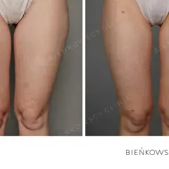 Liposukcja: modelowanie sylwetki czy odchudzanie? Sprawdź, co musisz wiedzieć