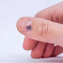 Ein blauer Fleck unter dem Fingernagel, vielleicht durch einen Stoß. Hausmittel können bei solchen Blutergüssen helfen.