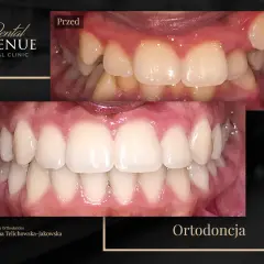 Aparat ortodontyczny przed i po: krzywe zęby wyprostowane, piękny uśmiech. Ortodoncja w Dental Avenue.