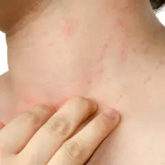 Pelle arrossata e irritata sul collo e sul petto, con piccole macchie rosse, sintomo di dermatite da stress.