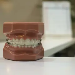 Model szczęki z widocznym aparatem na zęby zewnętrznym. Metalowe zamki i łuki korygują ułożenie zębów.