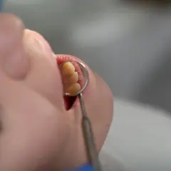 Usta pacjenta z widocznym 9 zębem, oglądanym przez dentystyczne lusterko.