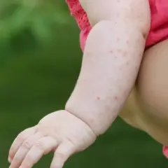 Różowe plamki na skórze dziecka, widoczne na ręce i ramieniu, mogą być jednym z objawów odry u dzieci.