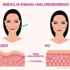 Kwas hialuronowy: jak działa i dlaczego Twoja skóra go pokocha?