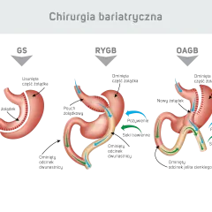 Ilustracja przedstawia trzy typy operacji bariatrycznej: GS, RYGB i OAGB, pokazując zmiany w żołądku i jelitach.