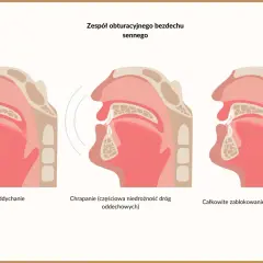 Ilustracja pokazuje przekrój dróg oddechowych. Od normalnego oddychania, przez częściową niedrożność powodującą chrapanie, aż do całkowitego zablokowania, które jest objawem bezdechu sennego.