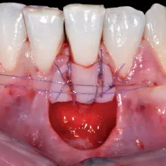 Primo piano di un innesto gengivale con suture viola che fissano il tessuto.