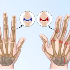 Vergleich von gesunden und entzündeten Gelenken der Hand, die chronische Polyarthritis zeigen.