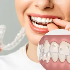 Una mujer sonríe mientras se coloca un alineador transparente. Un primer plano muestra dientes con pequeños ataches, revelando para que sirven los ataches: guiar el movimiento dental.