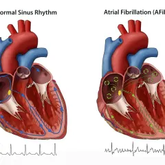 Porównanie prawidłowego rytmu zatokowego serca z migotaniem przedsionków (AFib). Rysunek pokazuje, jak impulsy elektryczne przepływają przez serce. Kardiowersja może pomóc przywrócić prawidłowy rytm.