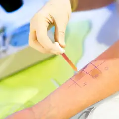 Test skórny w celu wykrycia uczulenia na wodę. Ręka pacjenta z zaznaczonymi polami do testów, na które aplikowana jest substancja.