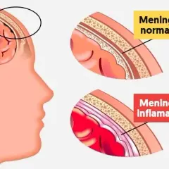 Síntomas de meningitis que no debes ignorar para tu salud