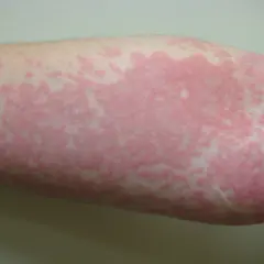 Roter, fleckiger Hautausschlag am Arm, möglicherweise ein Symptom von Corona.