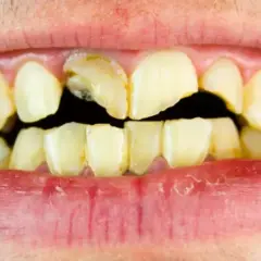 Dientes amarillentos y rotos, con caries visibles. Un triste reflejo de los dientes de drogadicto, que muestran el devastador efecto de las adicciones en la salud bucal.