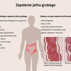 Ilustracja przedstawia objawy zapalenia jelita grubego: przewlekłe i ostre. Wymienione symptomy to m.in. biegunka, krew w kale, ból brzucha, gorączka.