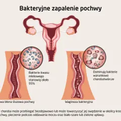 Ilustracja porównuje zdrową florę pochwy z dominacją bakterii kwasu mlekowego do waginozy bakteryjnej, gdzie przeważają bakterie chorobotwórcze.