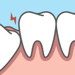 Dente incapsulato che fa male, con fulmini rossi che indicano dolore e gengiva infiammata.