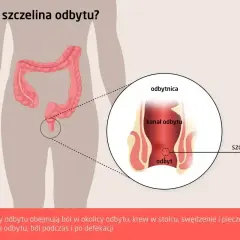 Ilustracja przedstawia anatomię odbytu z zaznaczoną szczeliną. Objawy szczeliny odbytu to ból, krwawienie i pieczenie.