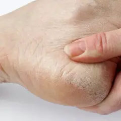 Suchy, popękany naskórek na pięcie, przypominający rogowiec krwawy, jest masowany palcami.
