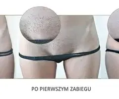 Depilacja laserowa bikini: Ile zabiegów dla gładkiej skóry na lata?