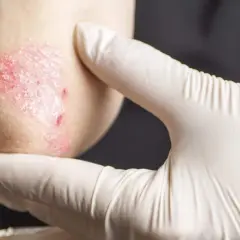 Gomito di un bambino con psoriasi, esaminato da una mano guantata.