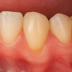 Dettaglio di denti con gengive sane. Si nota una piccola area di erosione a forma di V alla base di un dente, indicativa di abfraction dentale.