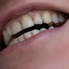 Zbliżenie na usta i zęby, w tym ząb mądrości który to, ukazujące ich naturalny wygląd.