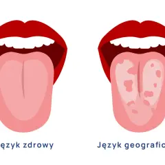 Dwa języki: zdrowy, różowy i gładki, obok języka geograficznego z plamami.