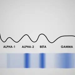 Wykres proteinogramu z frakcjami: albumina, alfa-1, alfa-2, beta, gamma. Widoczne pasma elektroforetyczne.