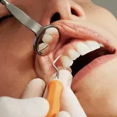 Esame dentale ravvicinato: uno specchietto riflette i denti mentre uno strumento dentistico esamina un dente, evidenziando una potenziale infezione dentale trascurata.