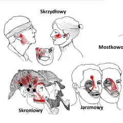Ilustracje pokazują punkty bólu związane z urazem szczęki po uderzeniu w różne obszary twarzy i szyi.