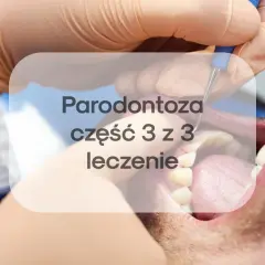Leczenie paradontozy laserem to nowoczesna metoda. Sprawdź, jaka jest laserowe leczenie paradontozy cena i jak przebiega zabieg.