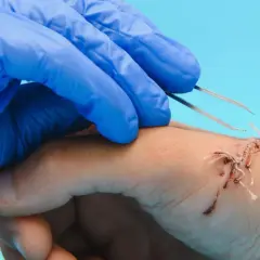 Main d'un professionnel en gant bleu utilisant une pince pour enlever un point de suture sur une main blessée.