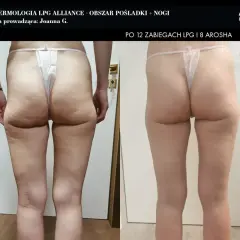 Endermologia: Ile cm stracisz w obwodzie? Mierzalne efekty!