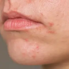 Haut um den Mund mit Rötungen und kleinen Pickelchen, typische Mundrose Symptome.