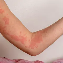 Braccia di un bambino con orticaria, eruzioni cutanee rosse e pruriginose. Immagini di orticaria nei bambini.