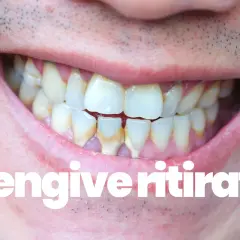 Denti con tartaro e gengive ritirate. Scopri le vitamine per gengive ritirate e migliora la tua igiene orale.