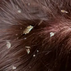 Primer plano de cabello castaño con escamas blancas visibles, indicando descamación del cuero cabelludo.