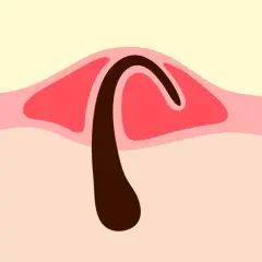 Illustration d'un bouton, montrant un poil pubien courbé sous la peau.