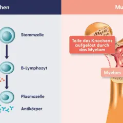 Vergleich gesunder Knochen mit Myelom. Bei Multiples Myelom werden Knochenteile aufgelöst, was zu Symptomen wie Schmerzen führen kann.