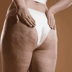 Dettaglio della coscia e del gluteo con cellulite, un'immagine che stimola la riflessione su come eliminare la cellulite e migliorare la propria pelle.