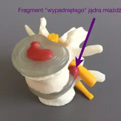 Model kręgosłupa z wypadniętym jądrem miażdżystym, wskazującym na potrzebę zaleceń po nastawianiu kręgosłupa.